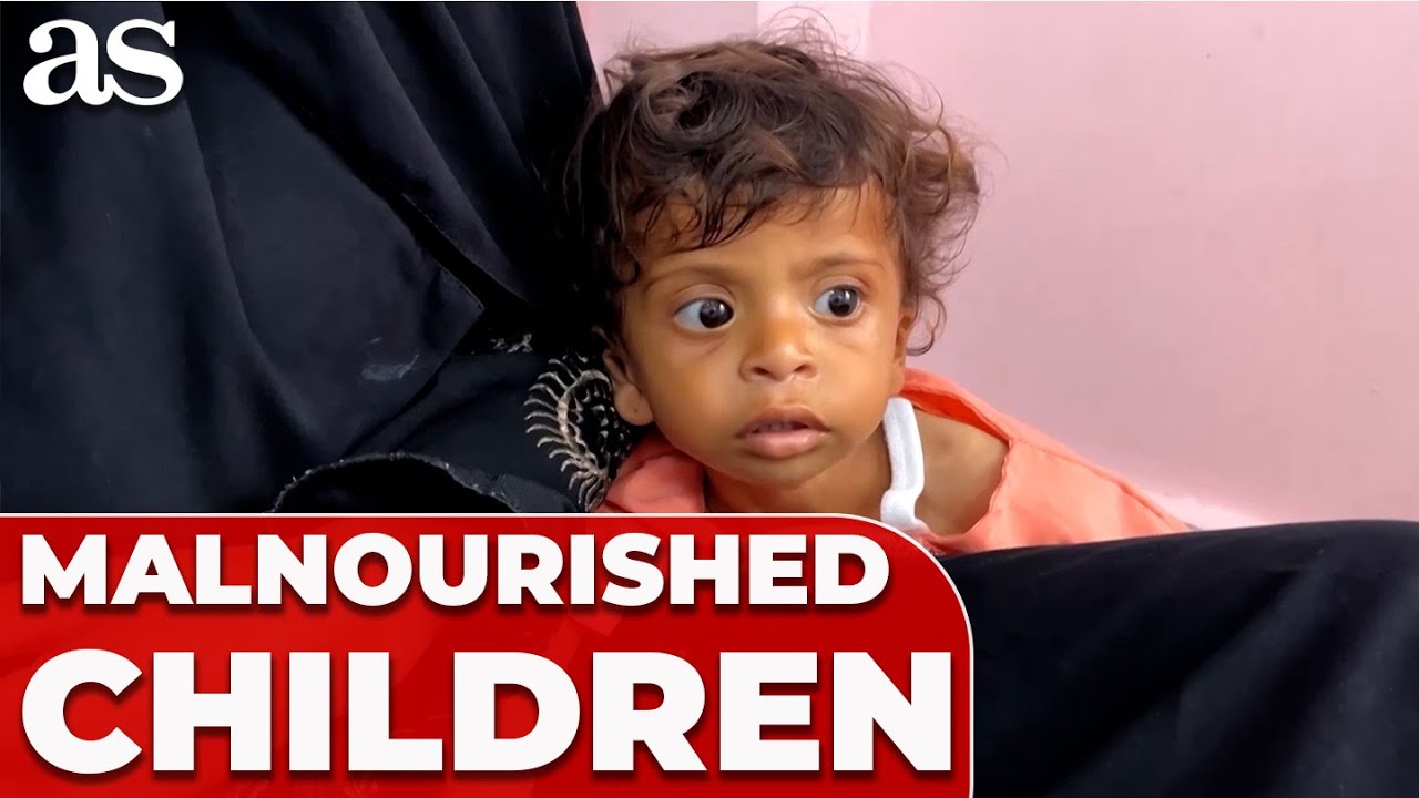 Gaza RUNNING OUT of SPECIALISED FOOD to SAVE MALNOURISHED CHILDREN