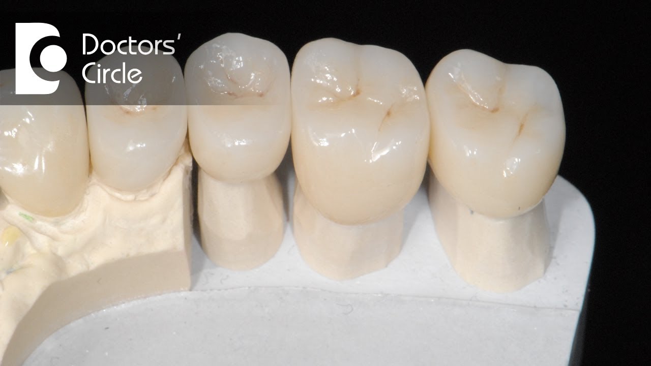 How long does crown placement takes? - Dr. Rajeev Kumar G