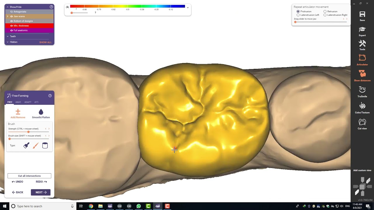 Shining 3D - Abutment and Restoration with digital dental solutions