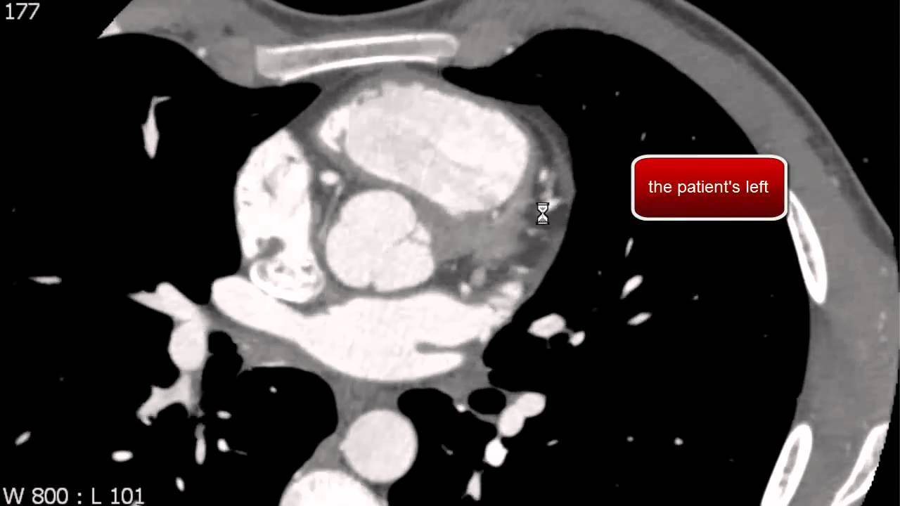 Left Anterior Descending Coronary Artery Anatomy on Coronary CTA