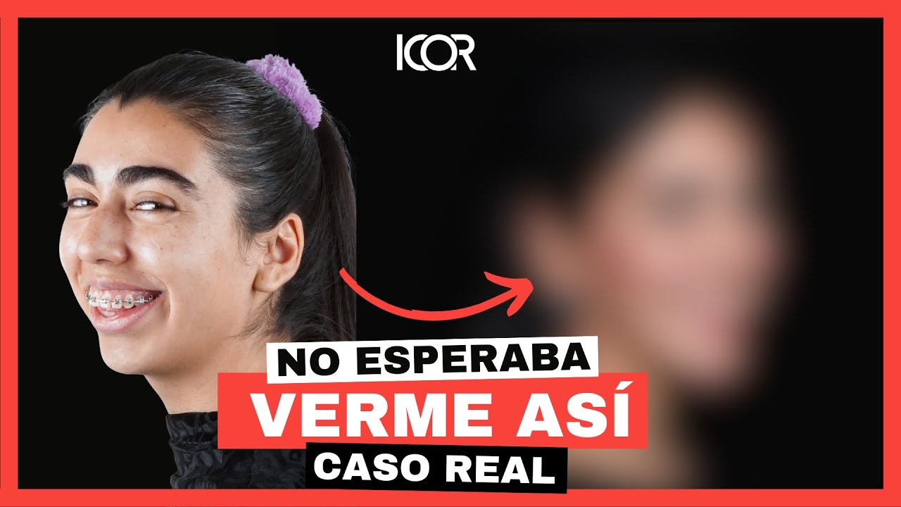 Caso clínico - Cirugía Ortognática Maxilofacial de paciente clase II