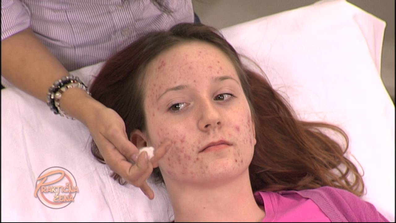 Praktična žena - Rešite se akni i bubuljica uz pomoć lakih trikova