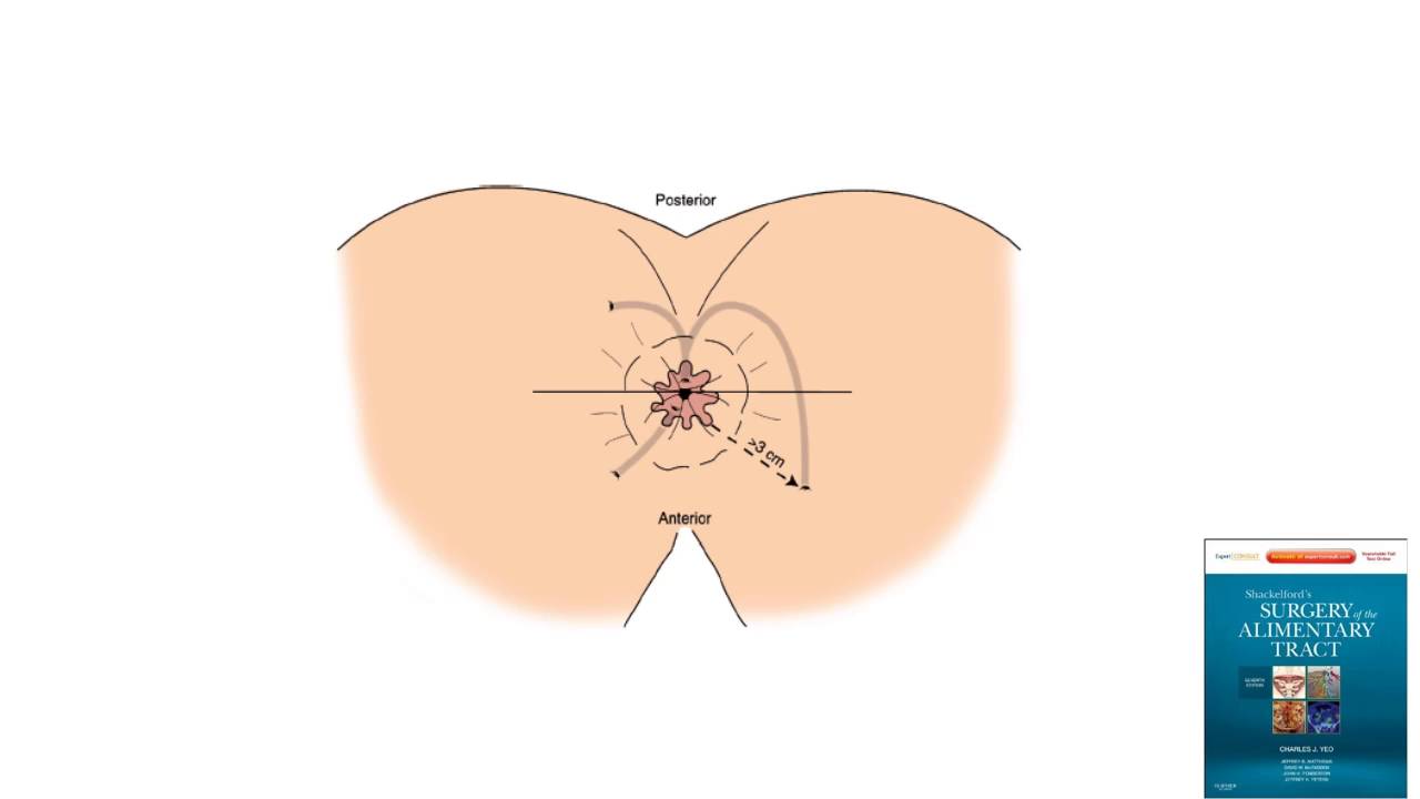 Goodsall&rsquo;s rule video