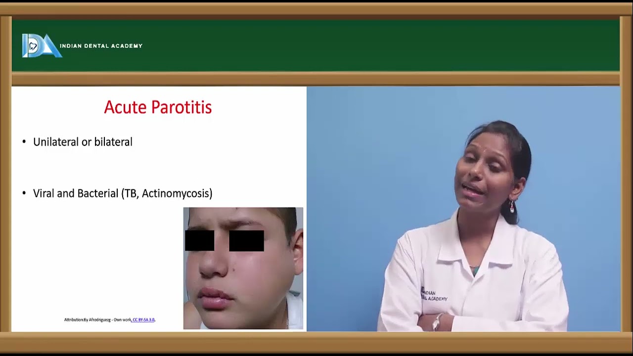 Salivary gland diseases | General surgery for Dentists | #NEET#MDS#BDS#NBDE#ORE#DDS
