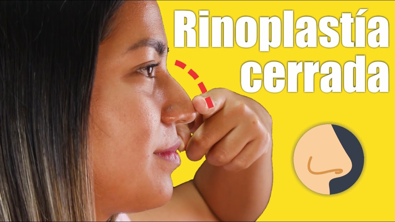RINOPLASTÍA CERRADA 👃🏼Le cambió el rostro  😍 Dr. Percy Nevado / Cirugía Plástica Nevado