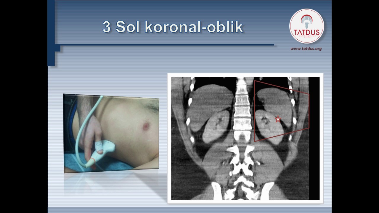 Acil Travma Ultrasonografisi   FAST