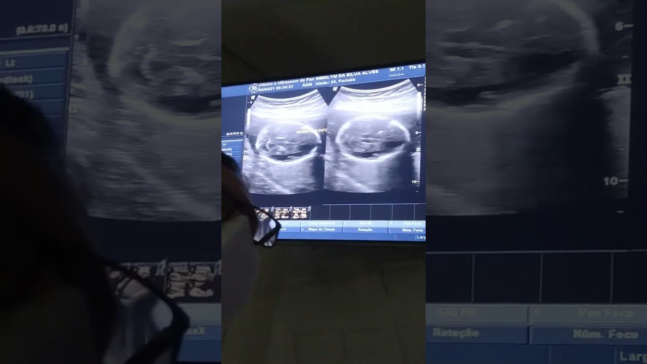 Ultrassom descobrindo sexo do meu primeiro bebê 