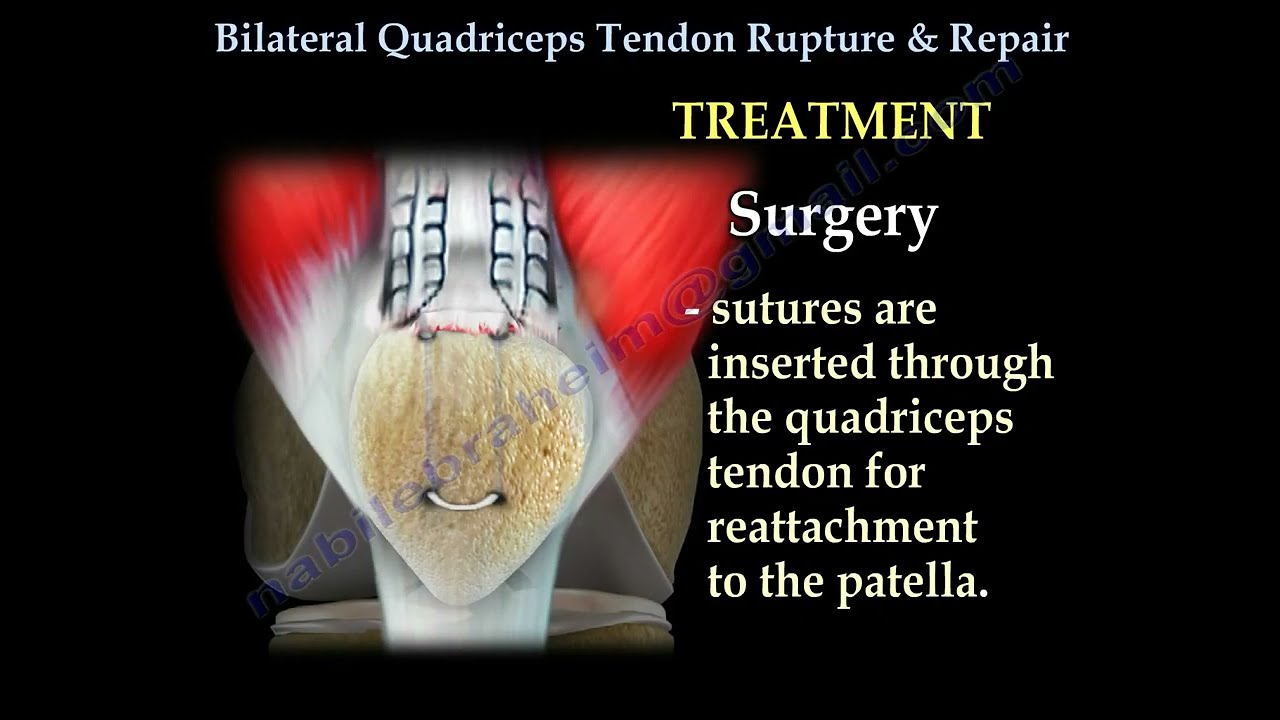 Bilateral Quadriceps Tendon Rupture & Repair   Everything You Need To Know   Dr  Nabil Ebraheim