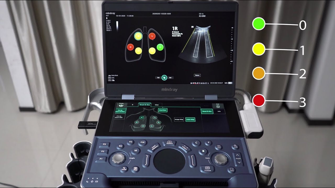 Mindray-ME Smart B-Line Demonstration