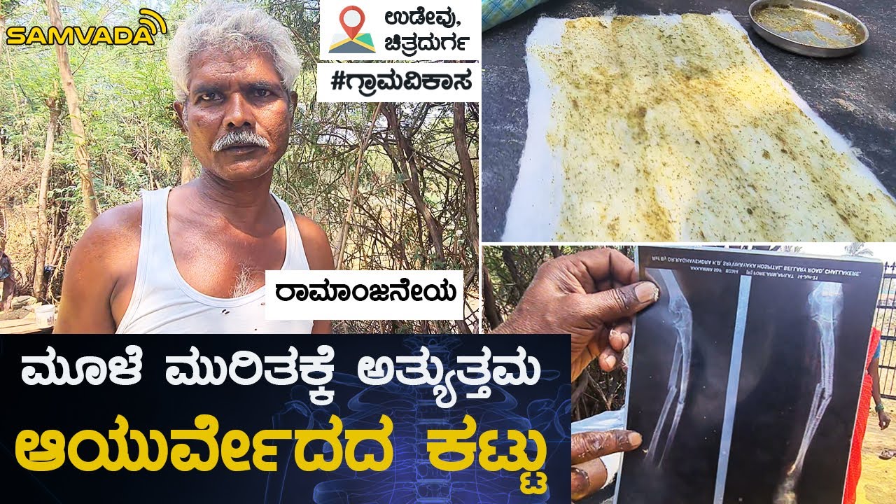ಮೂಳೆ ಮುರಿತಕ್ಕೆ ಅತ್ಯುತ್ತಮ ಆಯುರ್ವೇದದ ಕಟ್ಟು | ರಾಮಾಂಜನೇಯ