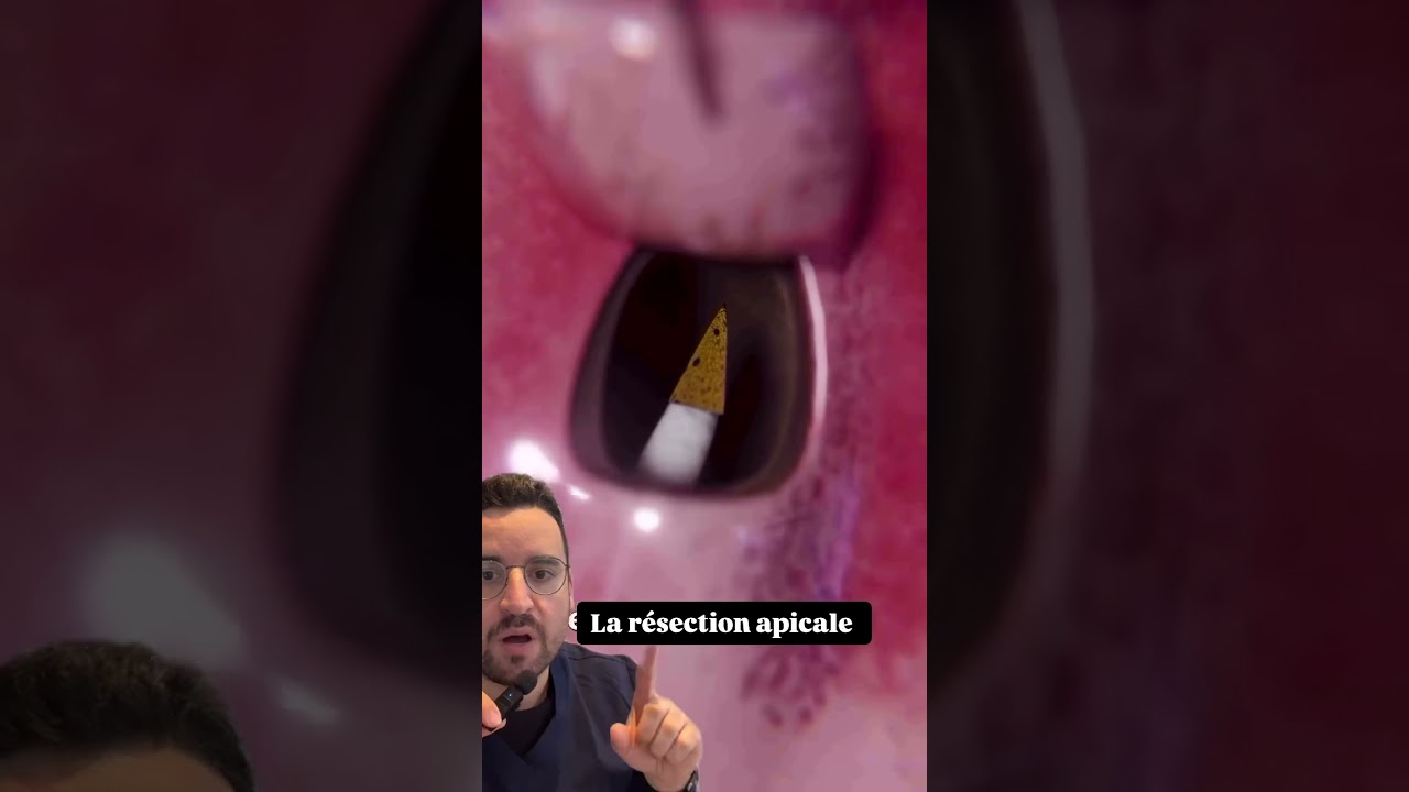 R&eacute;section apicale : la derni&egrave;re chance pour sauver une dent menac&eacute;e ?