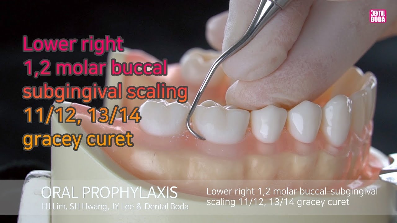 Lower right 1,2 molar buccal subgingival scaling 11/12, 13/14 gracey curet
