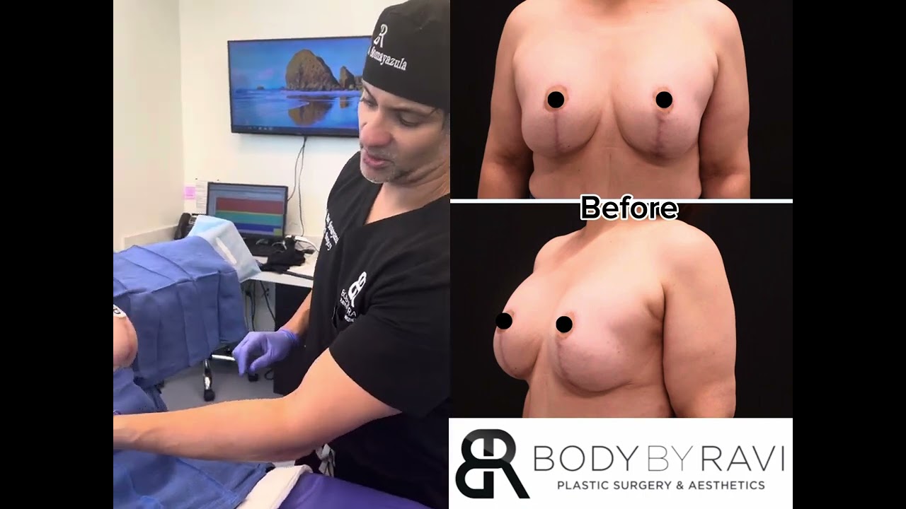 Watch Houston Plastic Surgeon, Dr Ravi during a Breast Implant Revision Surgery 