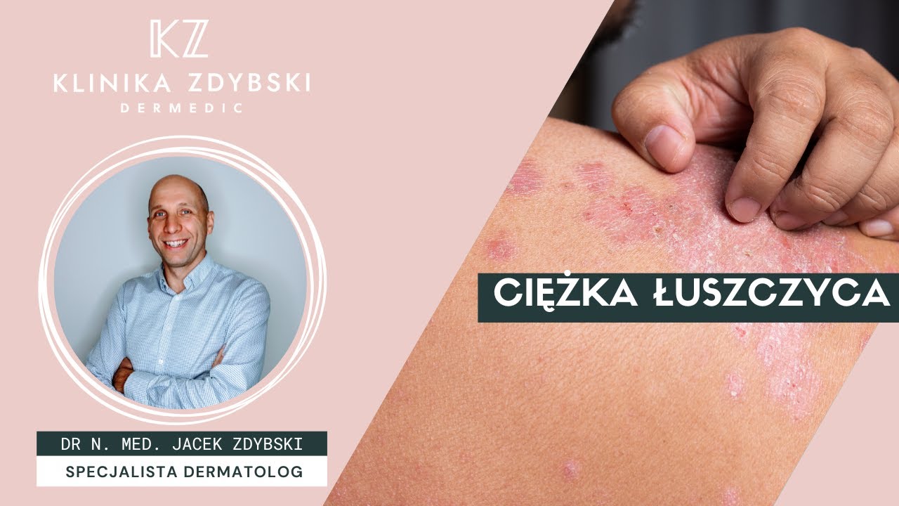 Dermatolog mówi o: ciężka łuszczyca a choroby serca