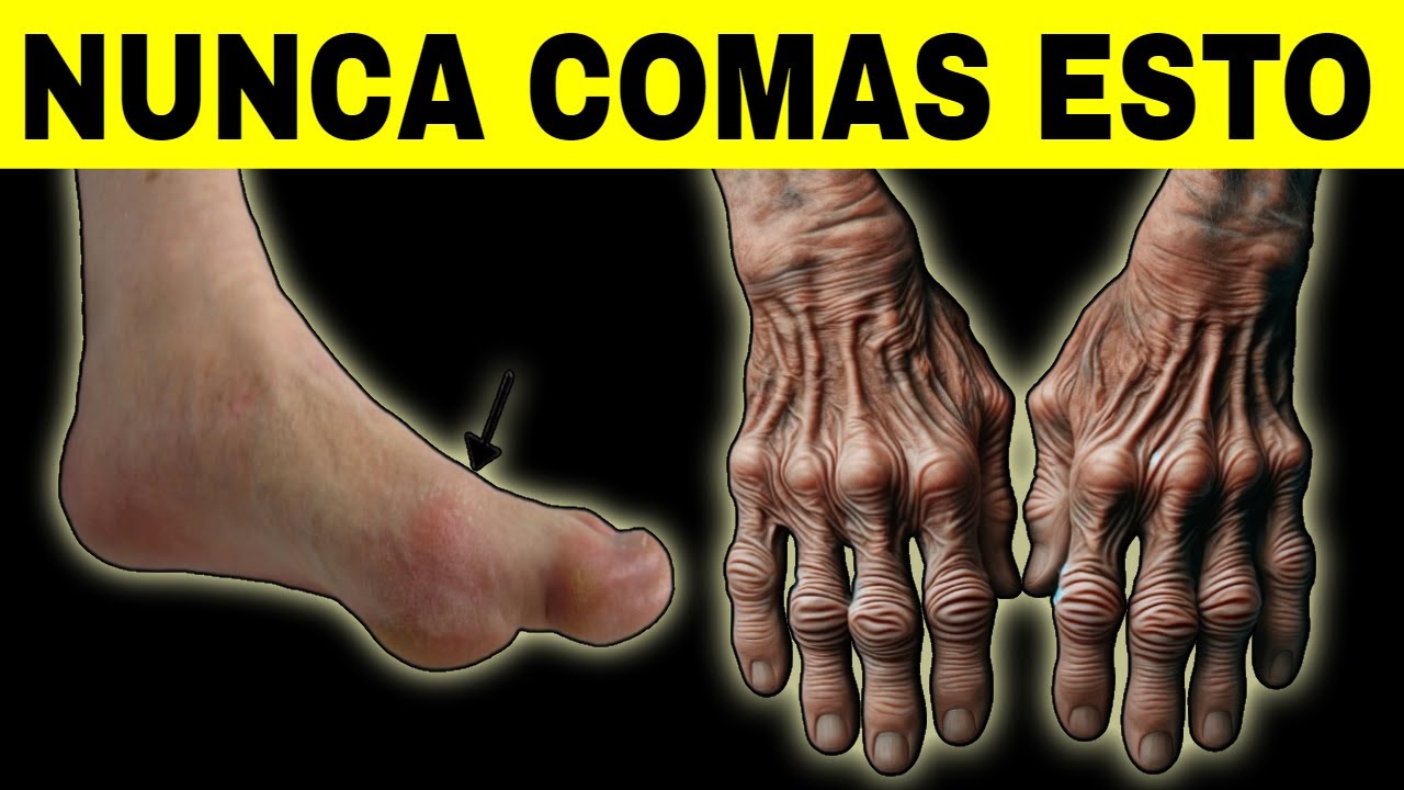 ARTRITIS (Alerta) NUNCA comas estos 10 alimentos