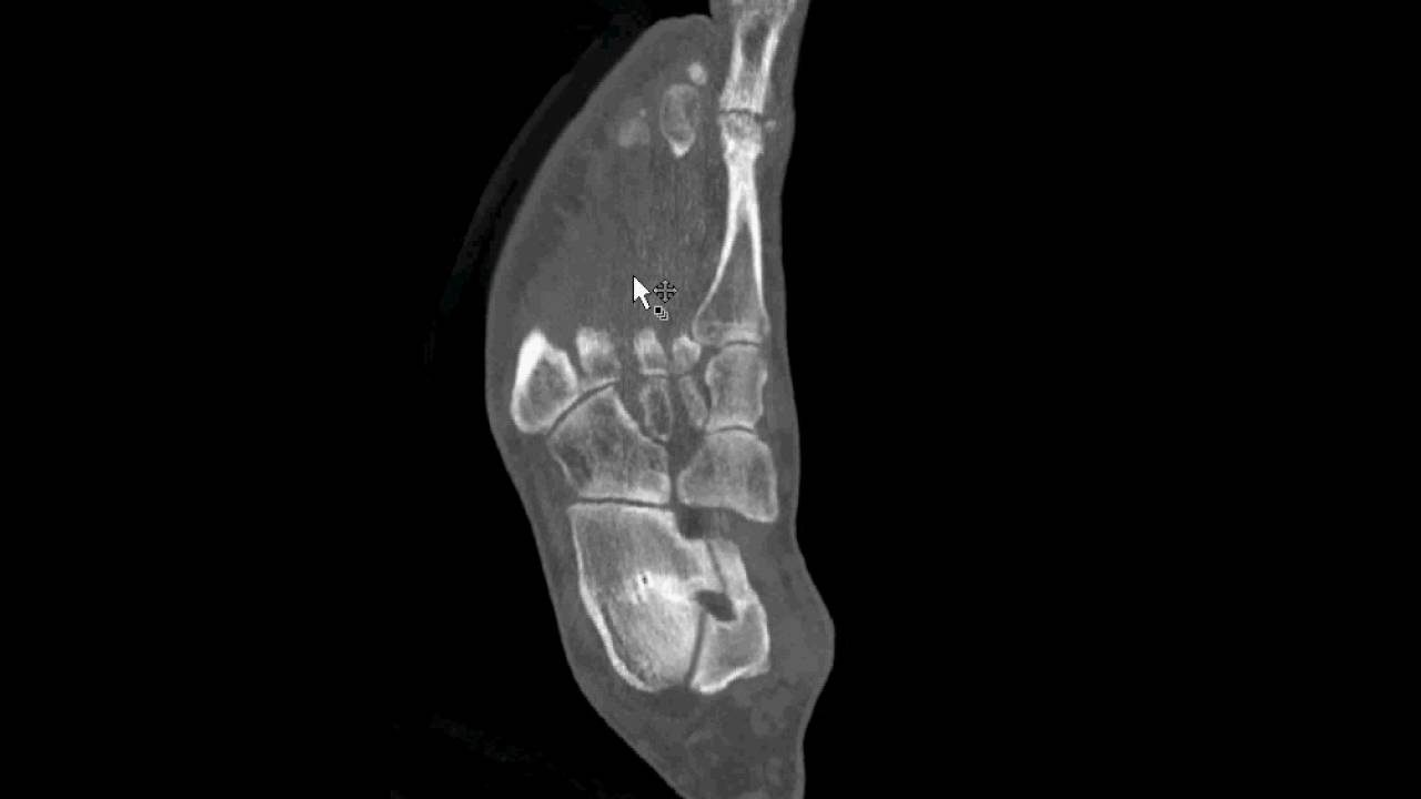 Forefoot CT imaging planes