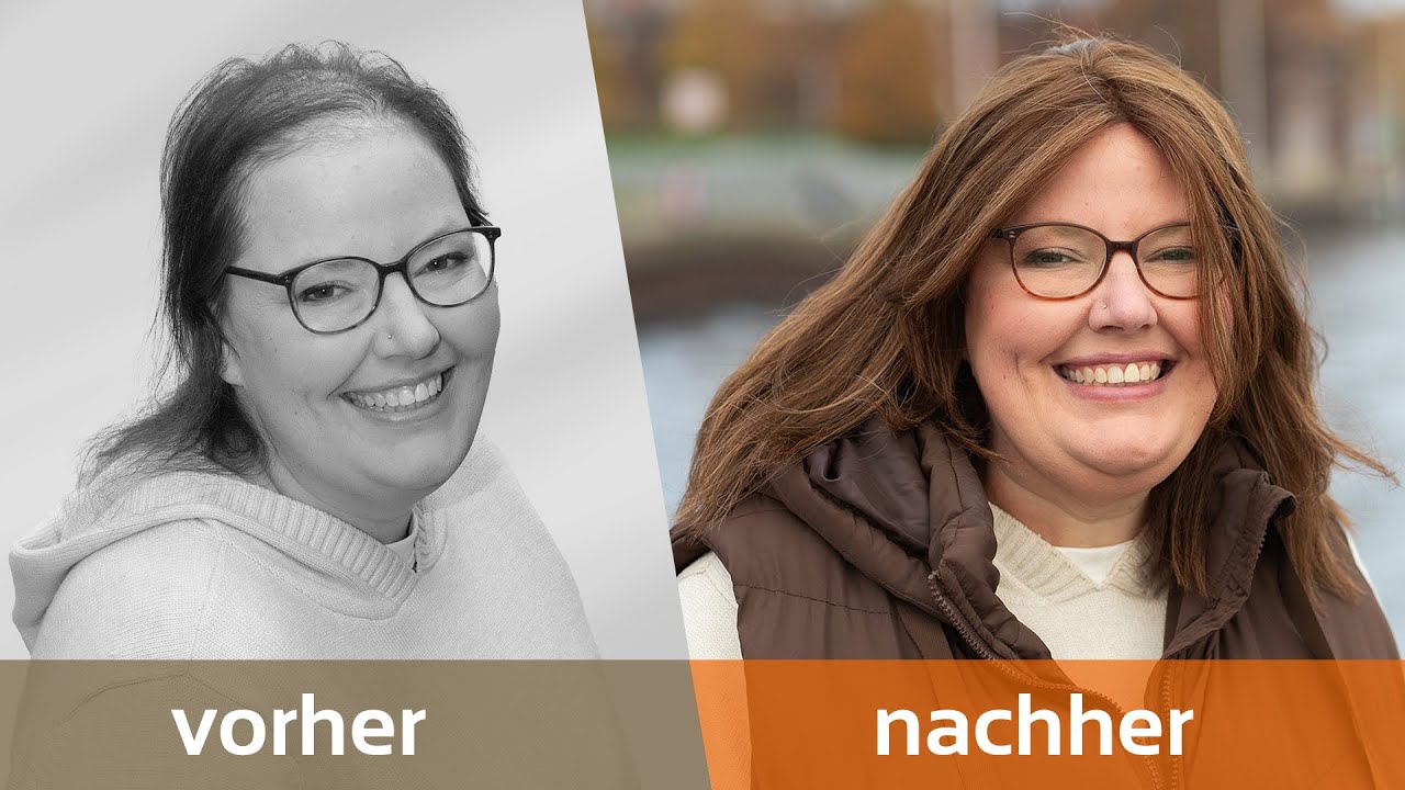 Eine permanente Haarverdichtung zur Versorgung von diffusem Haarausfall bei Frauen.