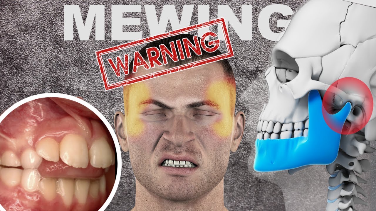 The Dangers of Mewing/Jawline Exercises