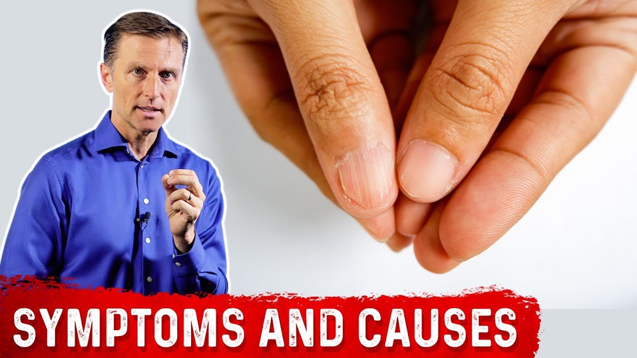 Iron Deficiency Symptoms and Causes of Anemia &ndash; Dr.Berg