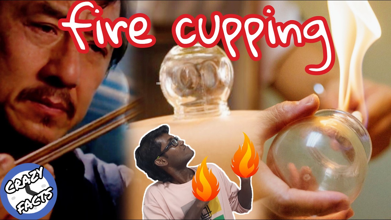 FIRECUPPING | A Health Technique | Tamil | The Medical Stupid