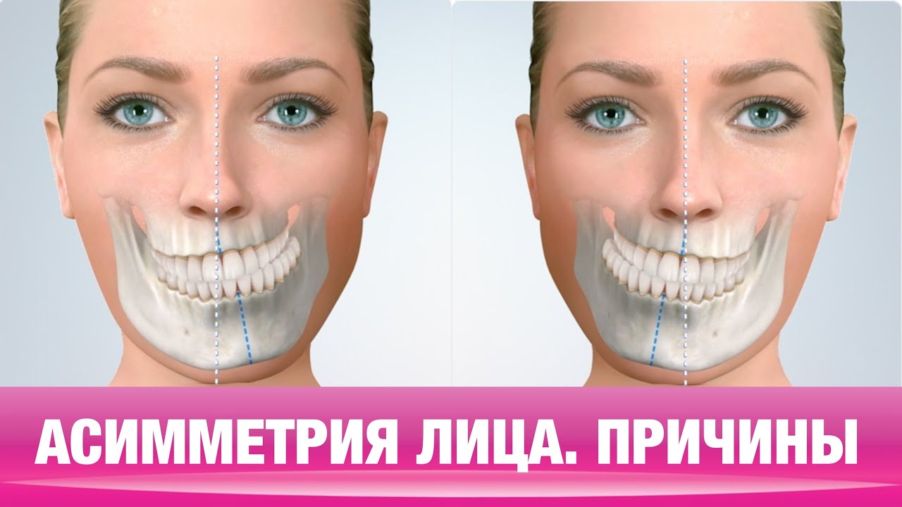 ОТКУДА БЕРЁТСЯ АСИММЕТРИЯ ЛИЦА.