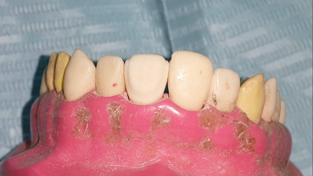 veneer preparation for dental students