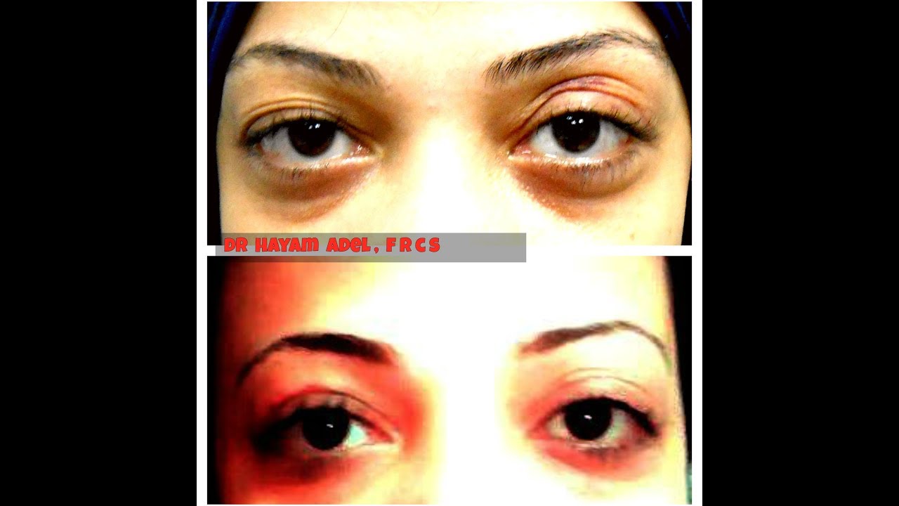 جفن واحد غائر وعينان مختلفتان د. هيام عادل    one hollow lid, different eyes!