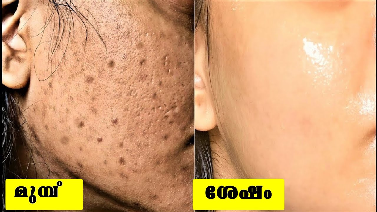 ഏതു നിറമില്ലാത്ത മുഖവും  നിറം വെക്കും പത്തു ദിവസം കൊണ്ട്  ഇങ്ങനെ ചെയ്താല്‍