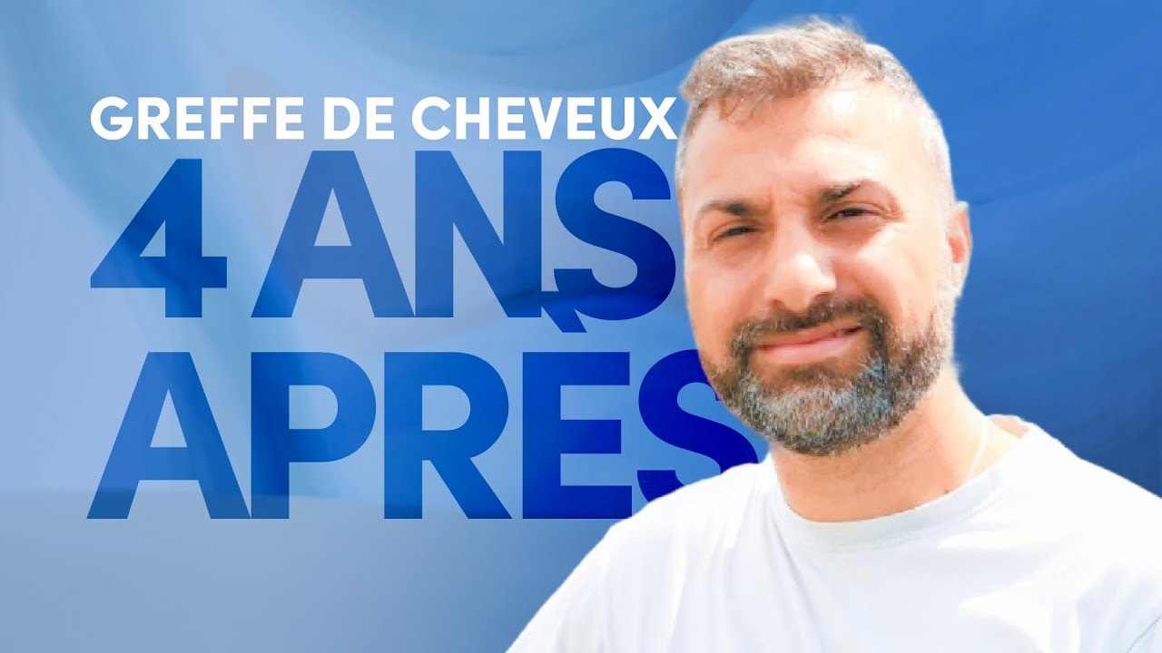 4 ans après sa greffe de cheveux… le VRAI résultat ! | Elithair