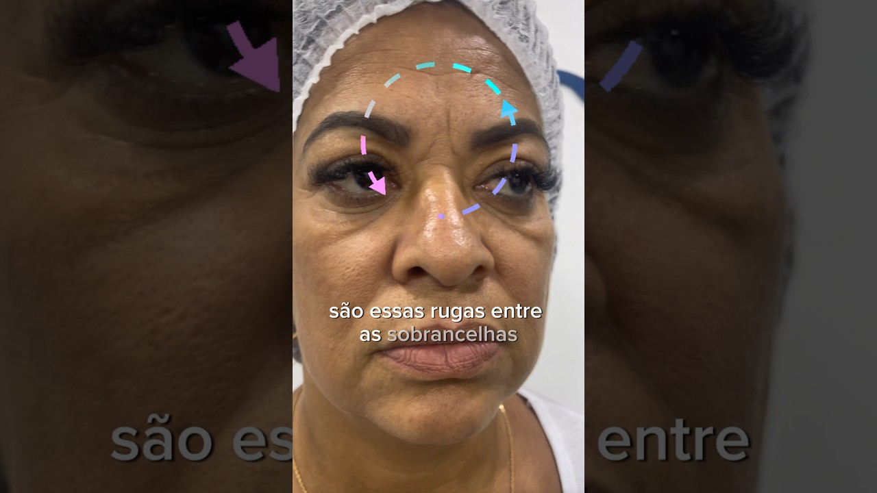 Como Reduzir as Rugas na Glabela Linhas de Express&atilde;o Entre as Sobrancelhas #botox #linhasdeexpress&atilde;o