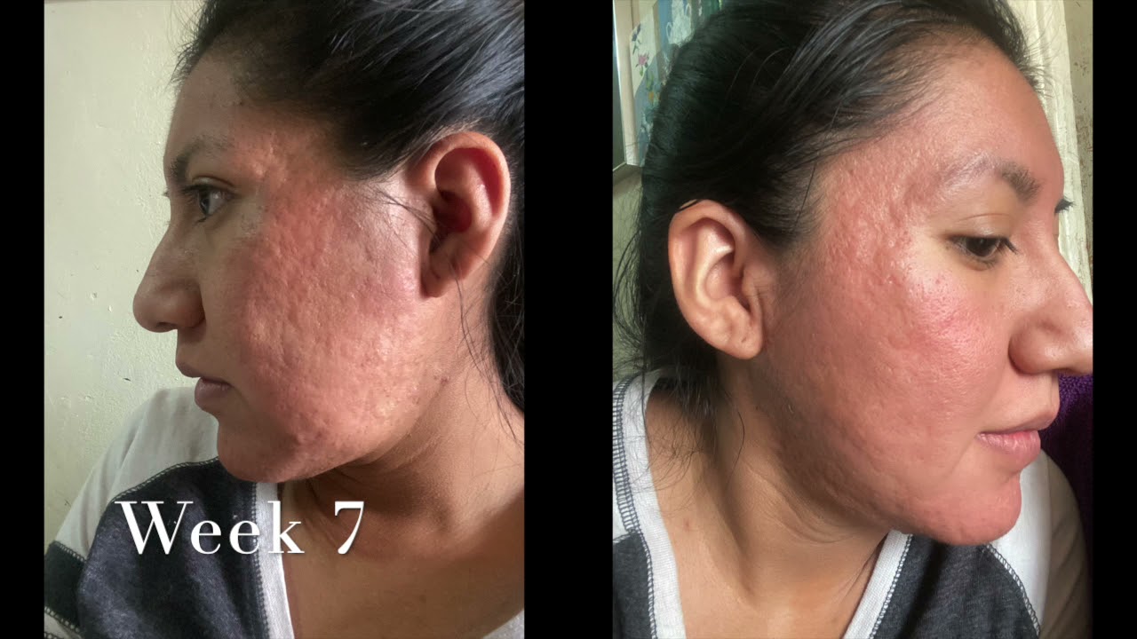 Using the Banish 2.0 for 3 months