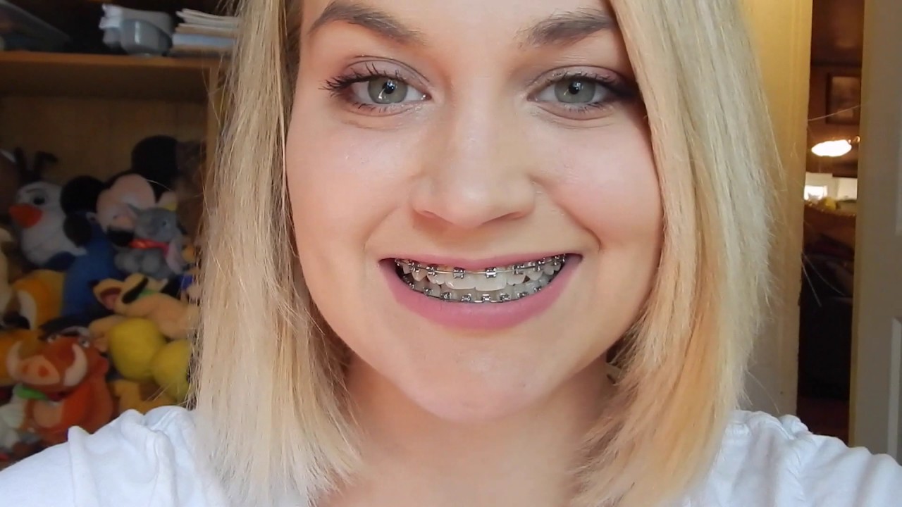 Just Over A Year With Braces / Up Close View