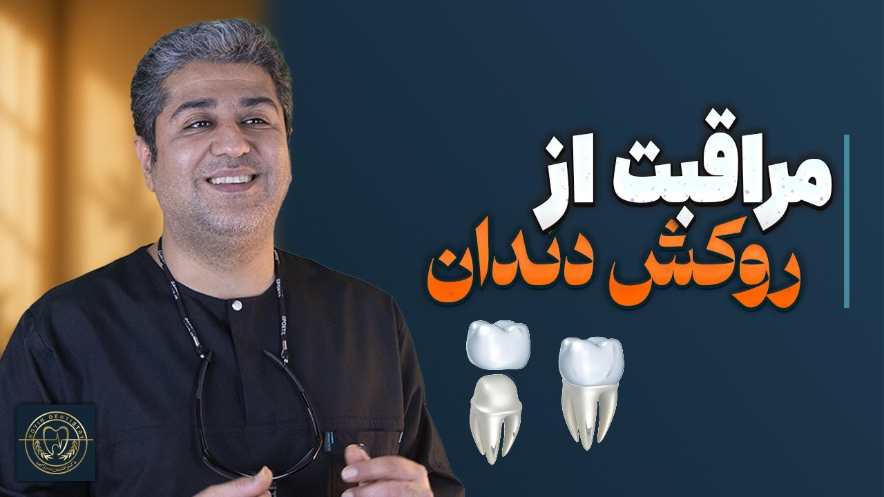 روکش دندان‌تان خراب نشود!نکات طلایی مراقبت از روکش