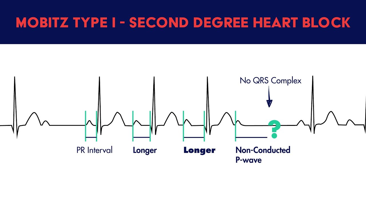 Second Degree Heart Block - Mobitz Type I