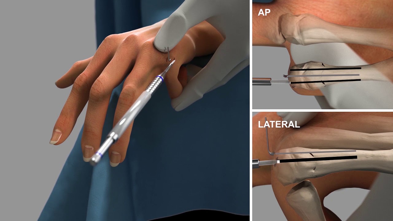 Bioretec ActivaPin™ 5th Metacarpal fracture fixation