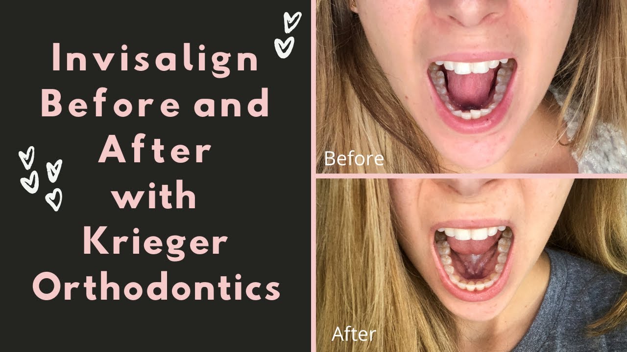 Invisalign Before and After Timelapse | Krieger Orthodontics | Running in Heels