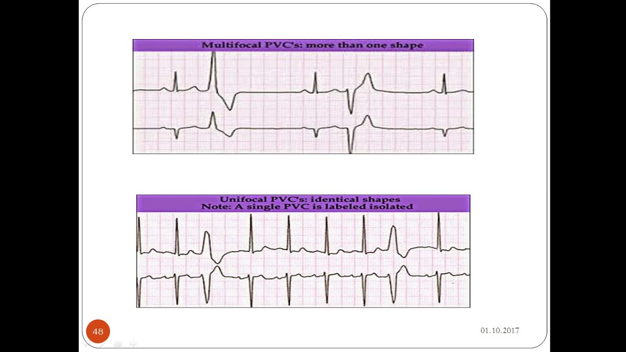 EKG ÖĞRENME, EKG,Prematür Ventriküler Kompleks (PVC)
