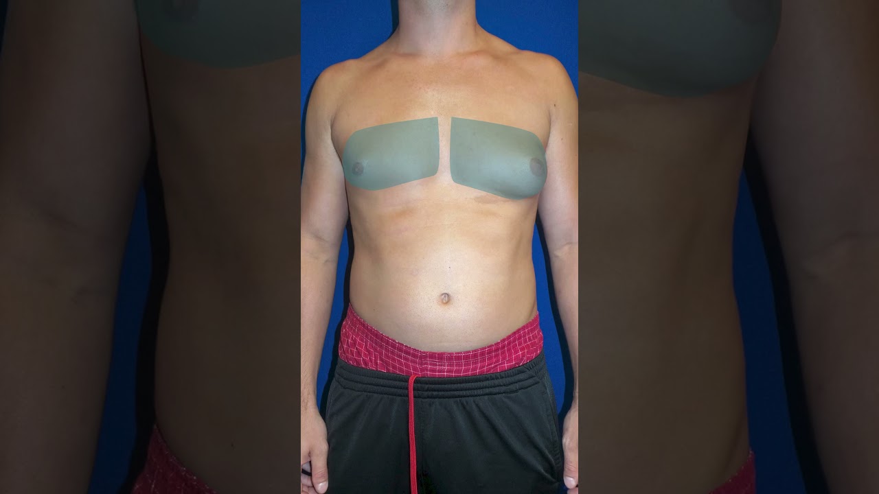 Gynecomastia and Armpit Fat Removed by Board Certified Plastic Surgeon