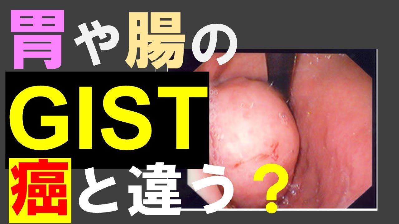 胃や腸にできるGIST（消化管間質腫瘍）とは？癌とどう違うの？