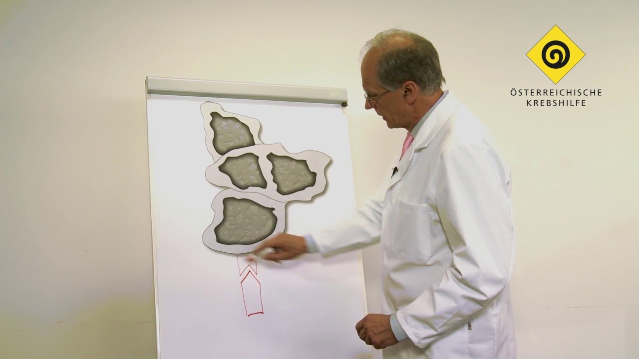 Therapien bei Krebs - Antihormontherapie