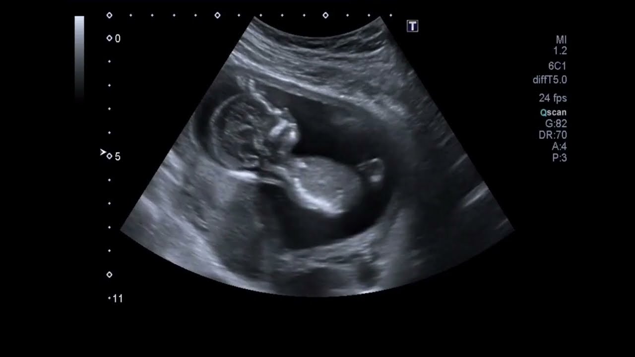 Beautiful Ultrasound Video of 14 Weeks Pregnancy | Baby Girl