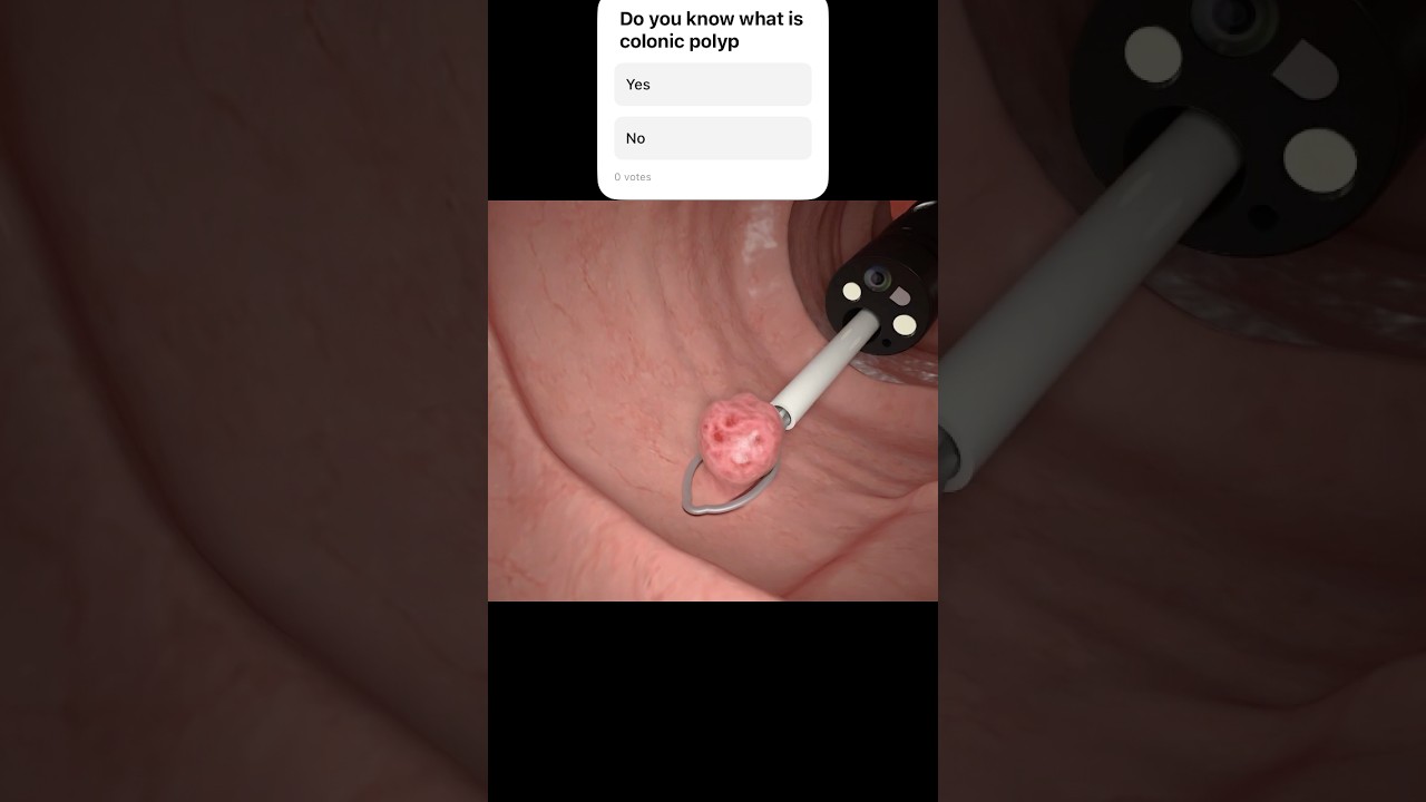 Polypectomy for colonic polyp #delhi #polyp #polypectomy