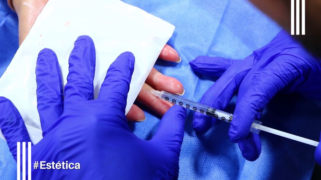 Tratamiento de Toxina Botul&iacute;nica para la Hiperhidrosis | Cl&iacute;nica Dermatol&oacute;gica Ollague