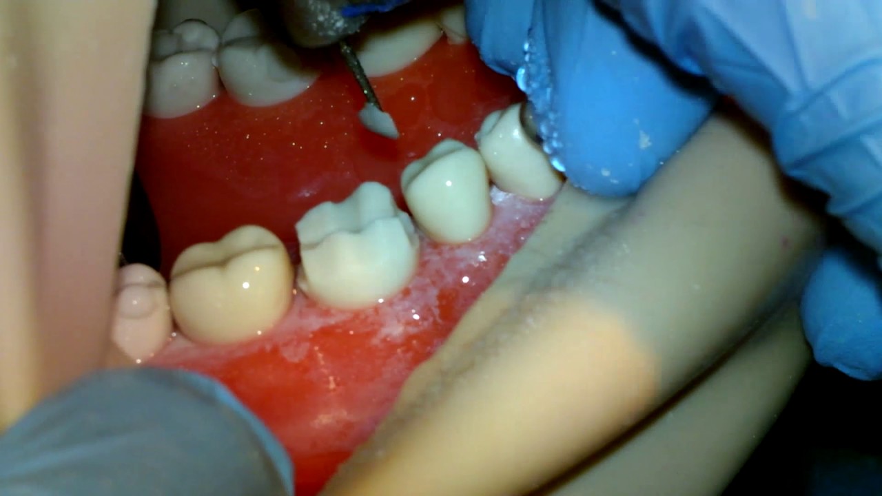 #30 PFM Crown Preparation