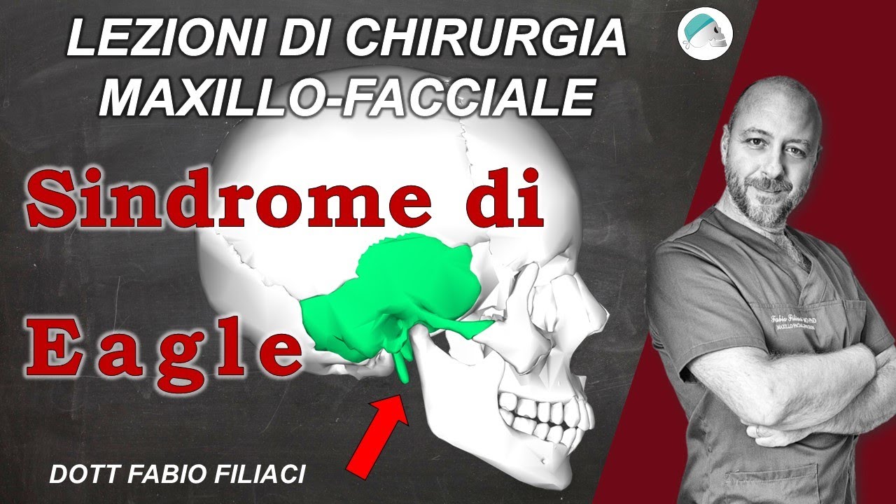 La sindrome di Eagle sintomi, trattamento, quando operare