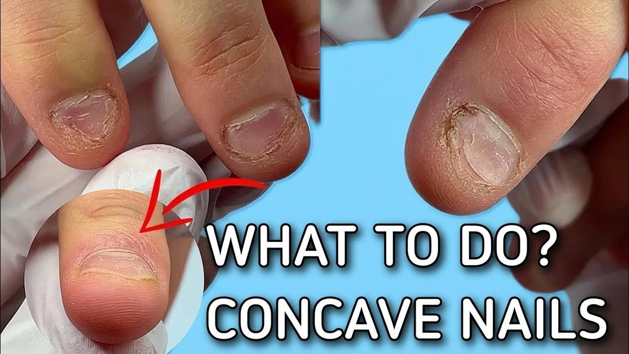 Saving a Nail-Biter's Damaged Nails