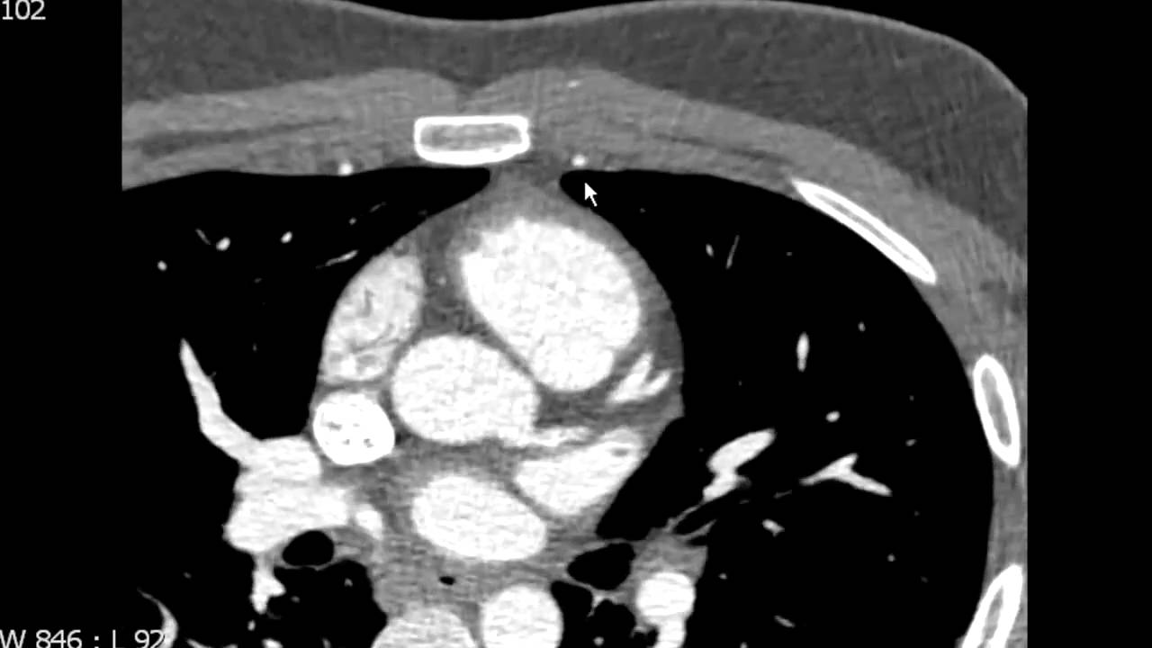 Left Circumflex Coronary Artery Anatomy on CTA