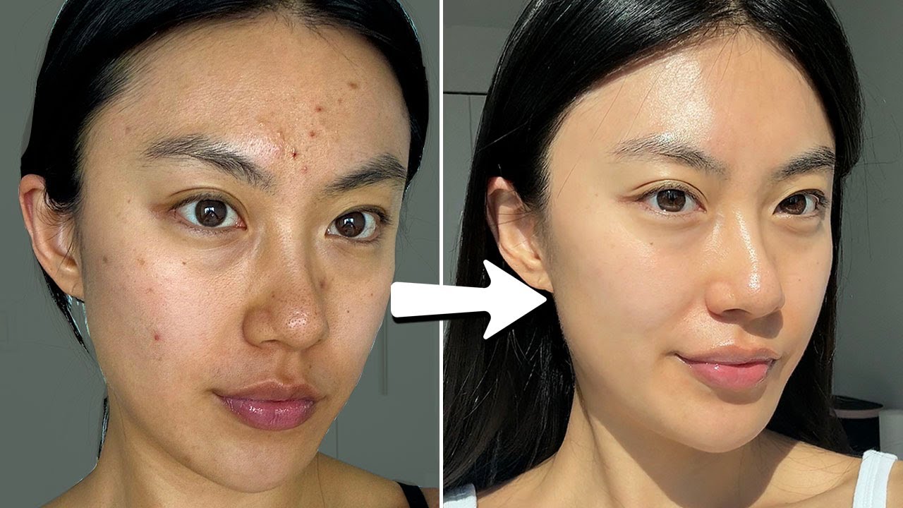 how I cleared my skin in a week with $0