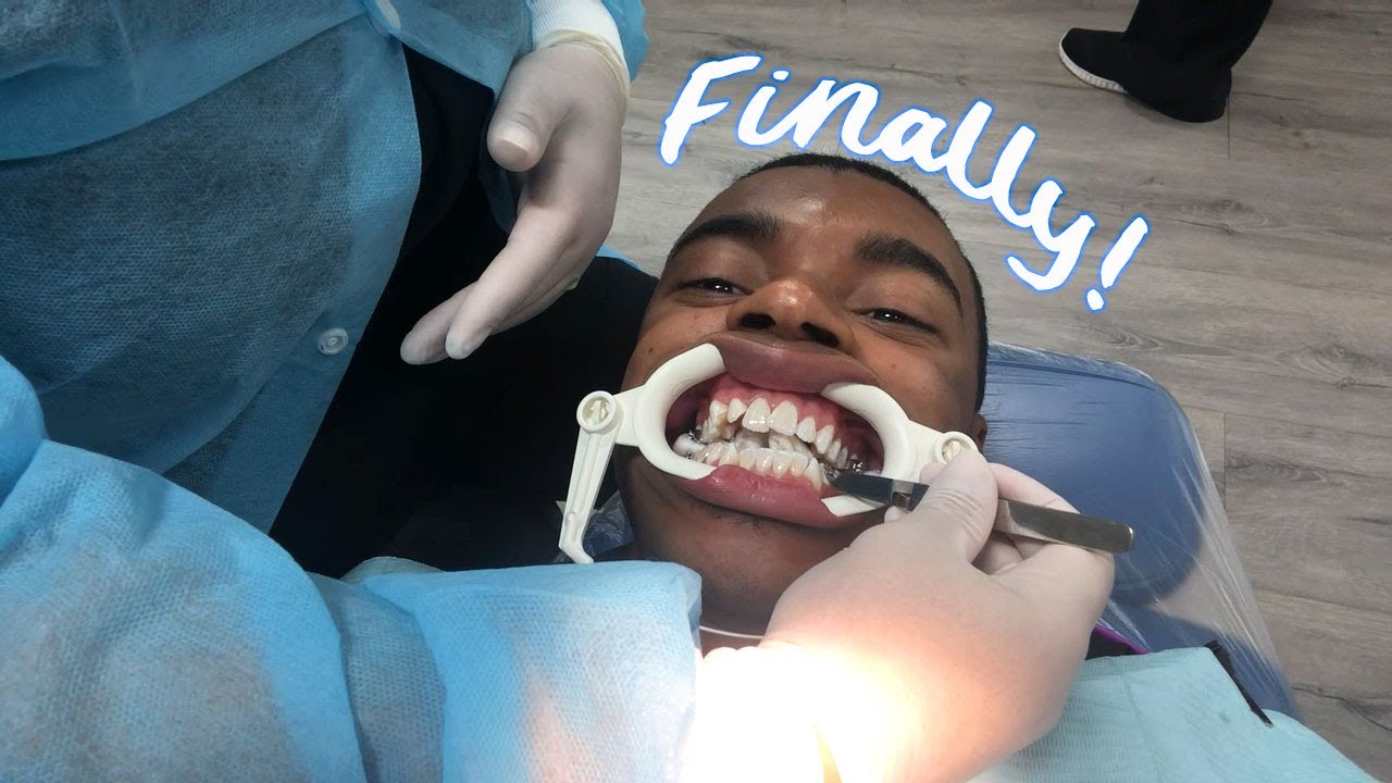 getting braces as an adult (severe case)
