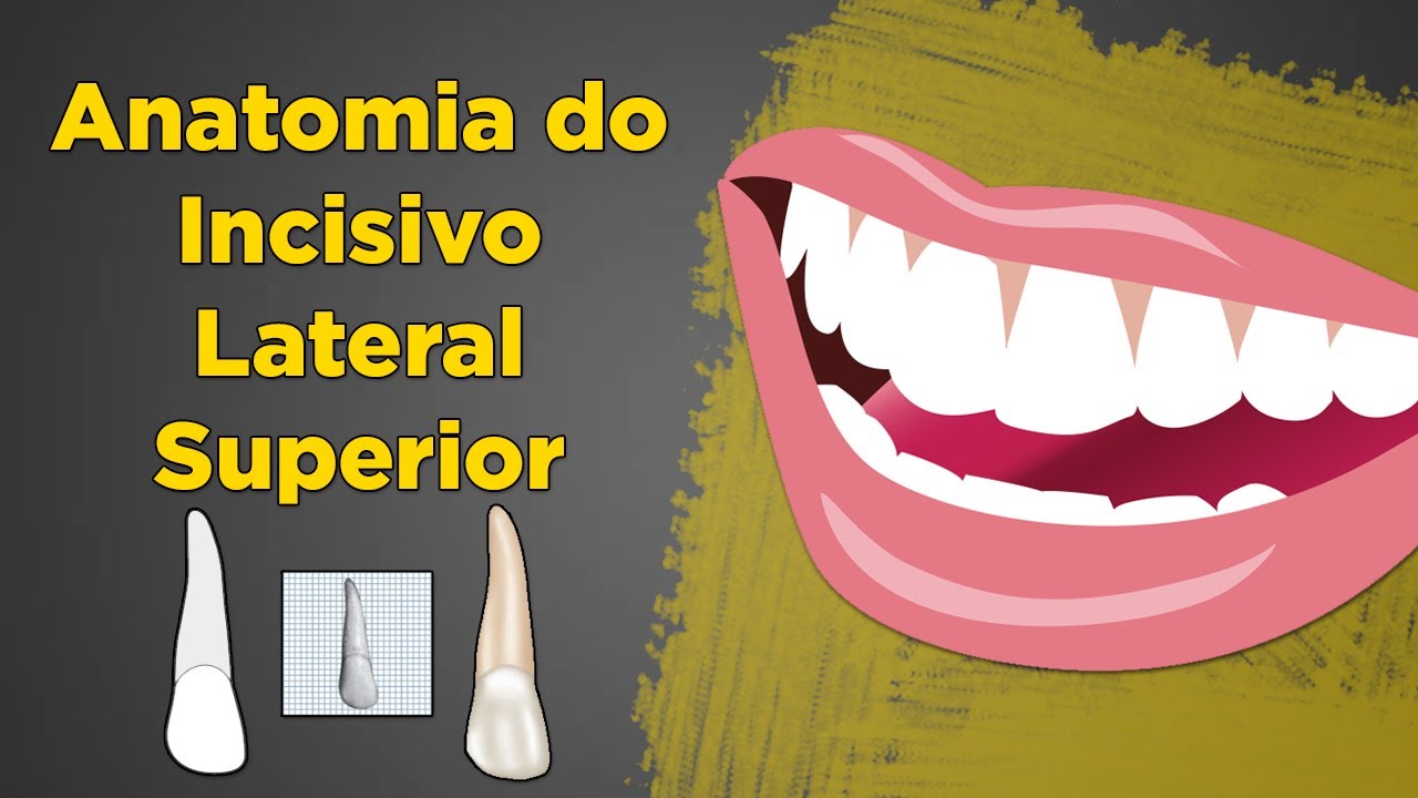 Anatomia do Incisivo Lateral Superior - Resumo de Anatomia Dental - Dente 12 e 22